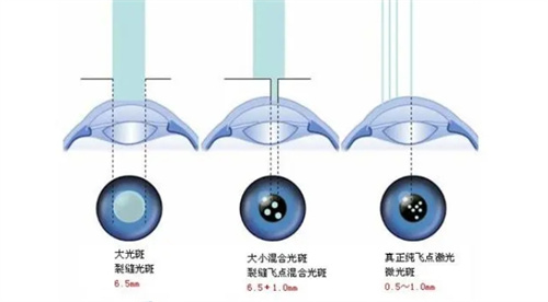 近视手术解析图