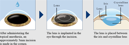 晶体植入手术晶体植入中