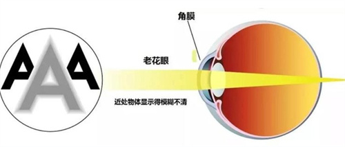 老花眼视光图