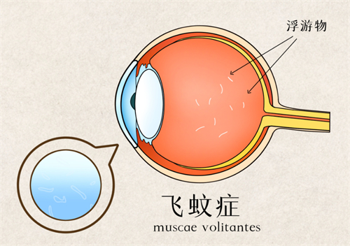 飞蚊症眼中浮游物的样子图解