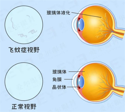 飞蚊症和正常眼睛的区别图解