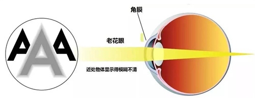 老花眼视光图