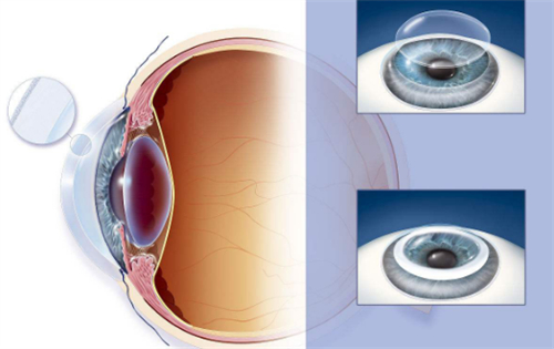 角膜移植手术过程图解