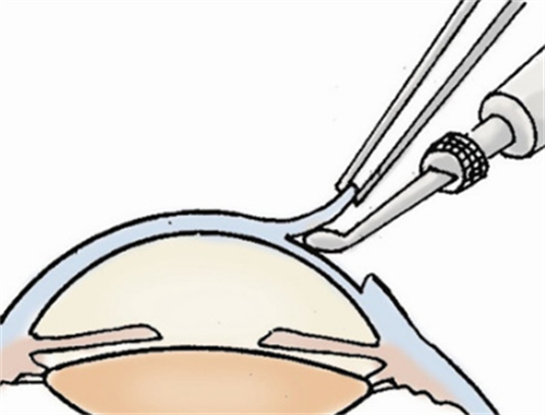 角膜移植手术过程图片