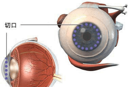 角膜移植手术切口位置图解