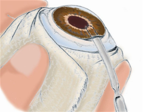角膜移植手术操作过程图解