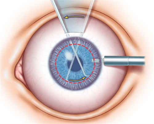 角膜移植切割位置图解
