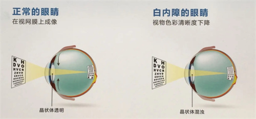 正常眼睛和白内障眼睛对比图