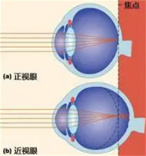 正常眼睛和近视眼镜的不同