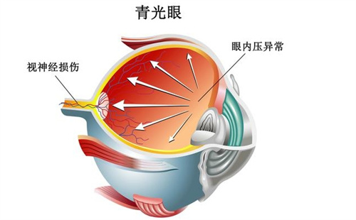 教你排除青光眼简单的检查方法!测量眼压是直接方便的方法之一!