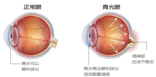 青光眼与正常眼对比图