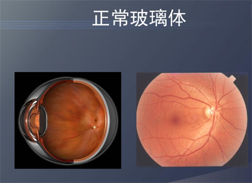 ​玻璃体液化的原因和解决方法分享，可通过手术治疗和药物治疗！