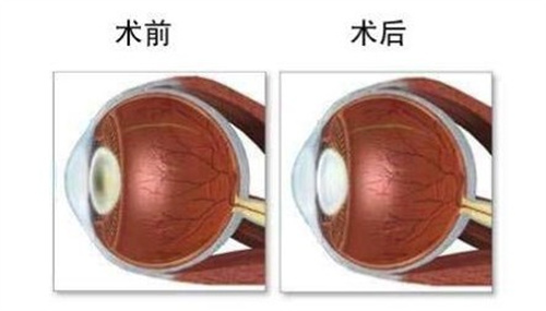 人工玻璃体植入手术前后