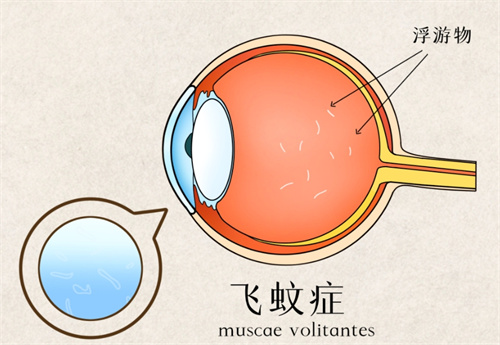 飞蚊症浮游物展示图