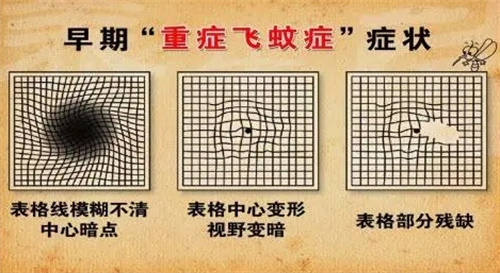 重症飞蚊症视光图