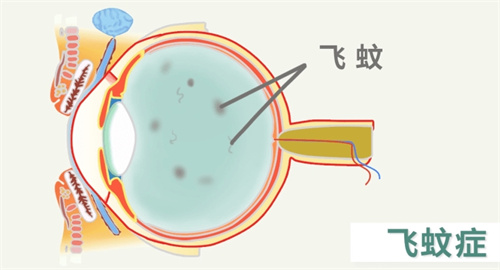 飞蚊症结构图