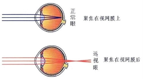 远视和老花有区别吗?除了佩戴眼镜还有什么好的治疗方法吗?