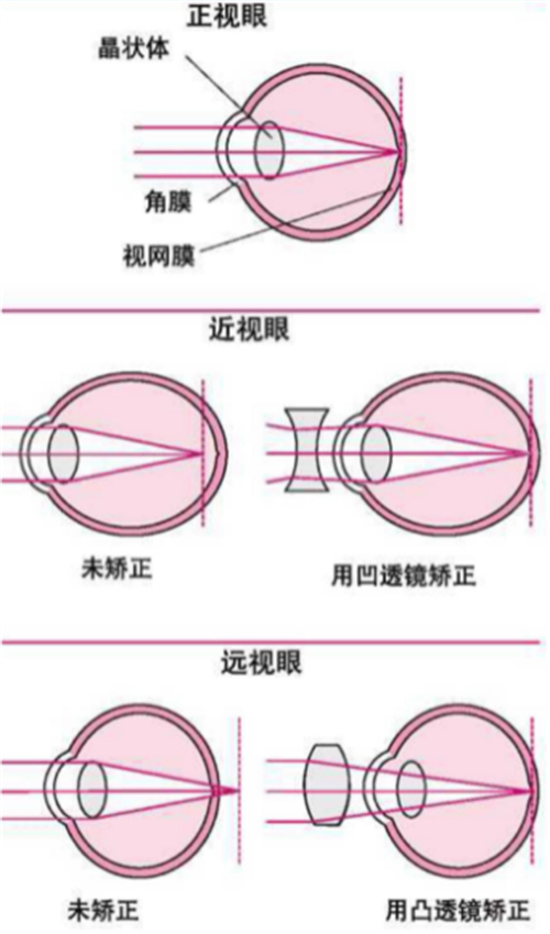 远视与近视眼球的区别图解