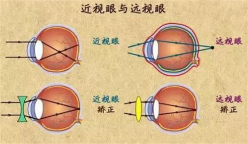 近视眼与远视眼的不同图解