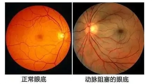 正常眼底和动脉堵塞眼底对比