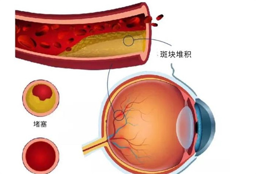 眼睛血管堵塞演示过程图