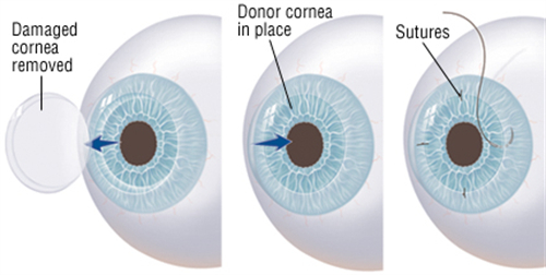 角膜移植的手术过程图