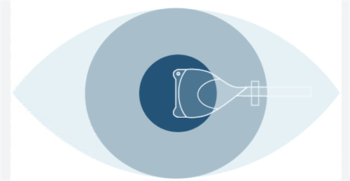 人工晶体植入手术图示