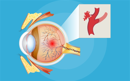 单只眼睛出血要警惕四种疾病:视网膜出血/眼球震颤综合征/眼球损伤/其他疾病等!
