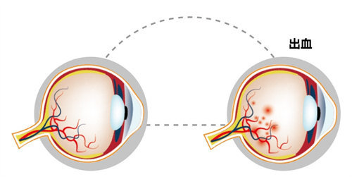 眼出血过程图