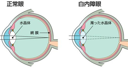 正常眼和白内障对比图