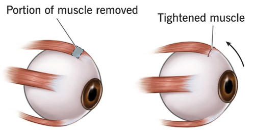 斜视眼睛的肌肉和正常眼镜肌肉不一样