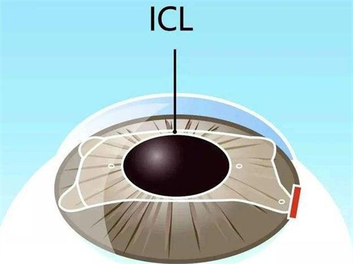 icl晶体植入动画图