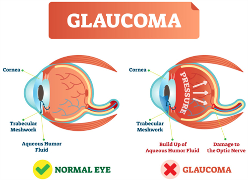 正常眼睛和青光眼的对比