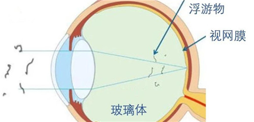 飞蚊症图.jpg