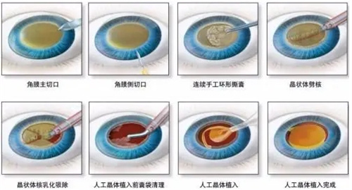 晶体植入过程图