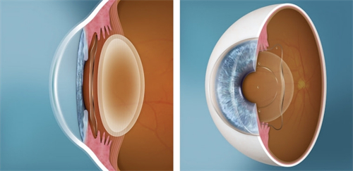 人工晶体植入眼睛对比