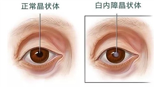 正常晶状体和白内障晶状体对比