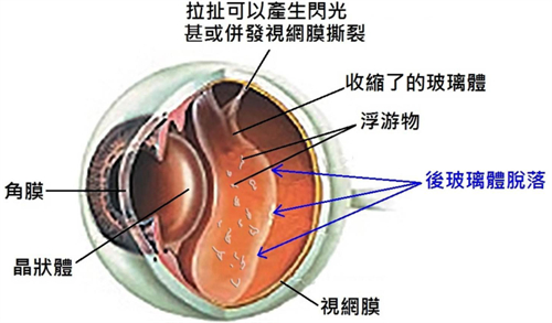 视网膜脱落症状