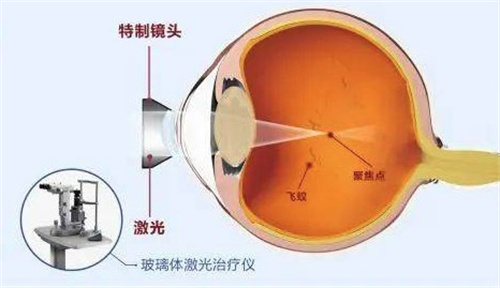 玻璃体激光治疗仪