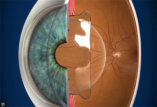 人工晶体植入图示