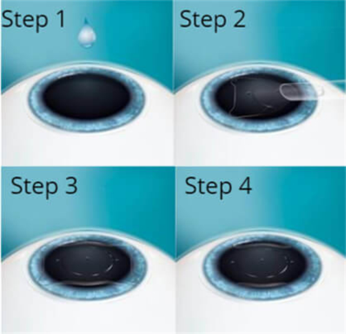 晶体植入手术过程演示图