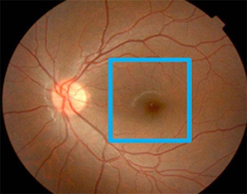 黄斑病变位置展示图