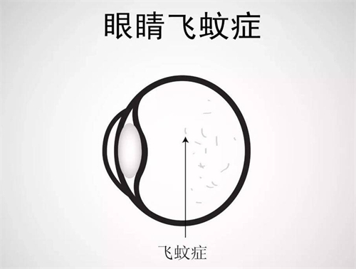 飞蚊症演示图