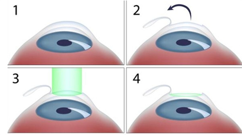 飞秒激光手术流程图