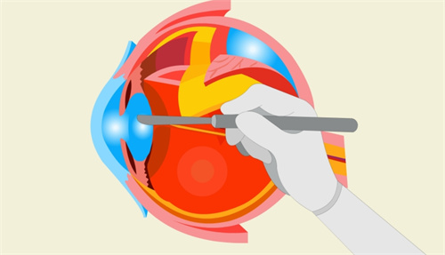 白内障手术动画图