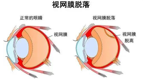 视网膜脱落和正常眼睛对比