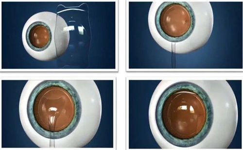 晶体植入手术流程图