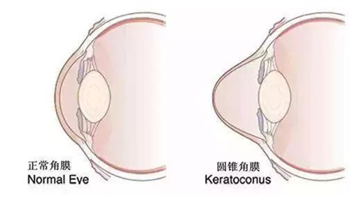 圆锥角膜示意图