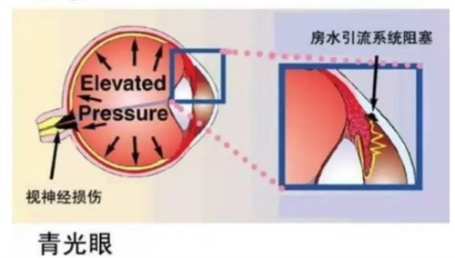 青光眼是什么原因导致的