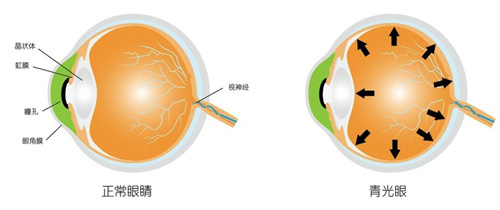 正常眼睛和青光眼